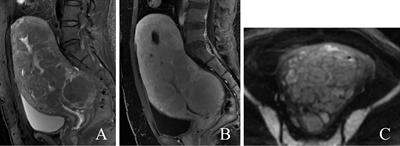 Case report: Magnetic resonance imaging findings of patients with diffuse uterine leiomyomatosis